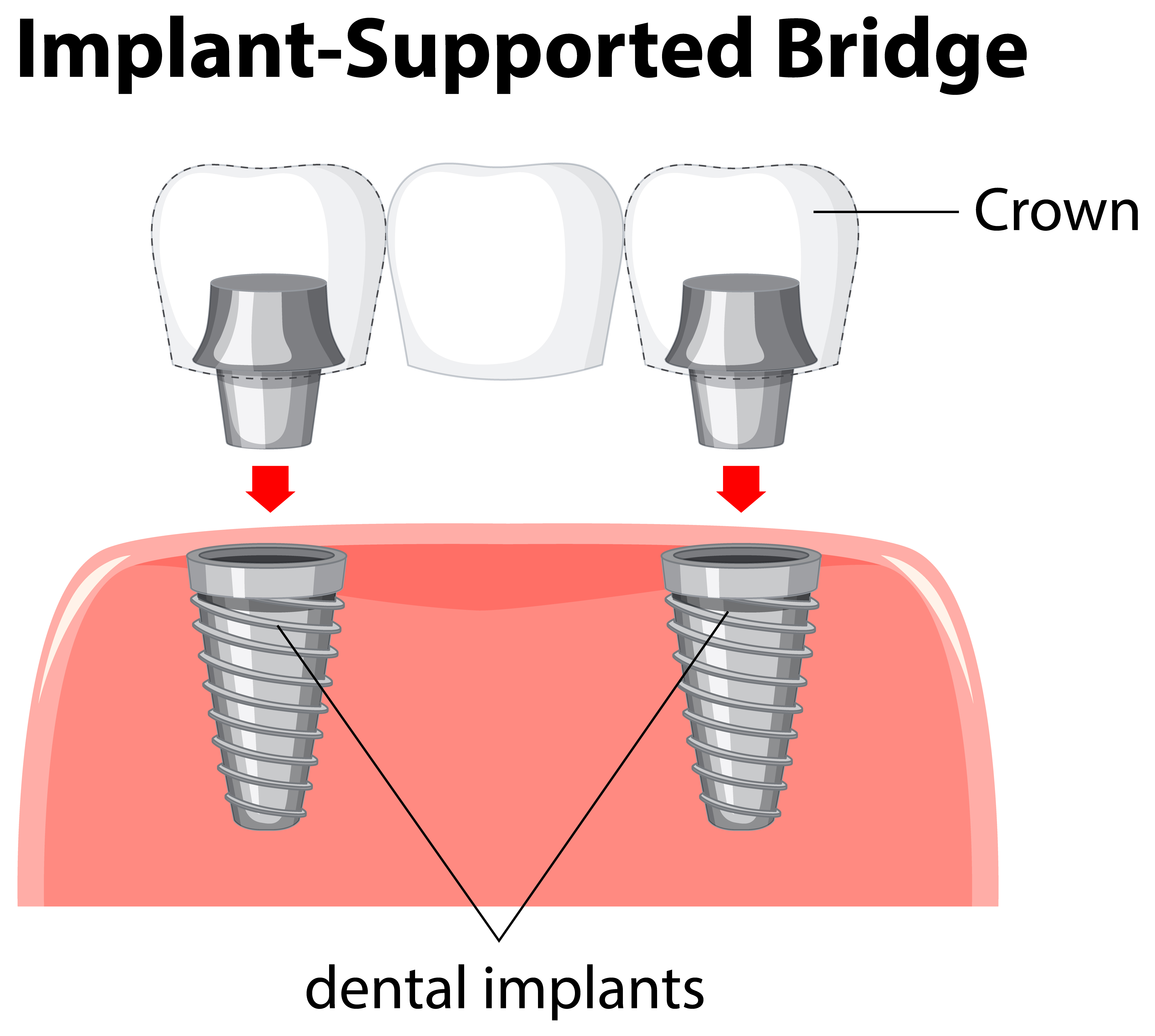 Implant supported Bridge