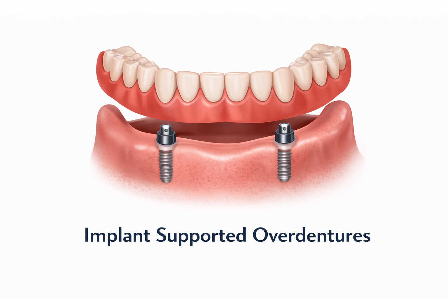 Implant supported Overdentures