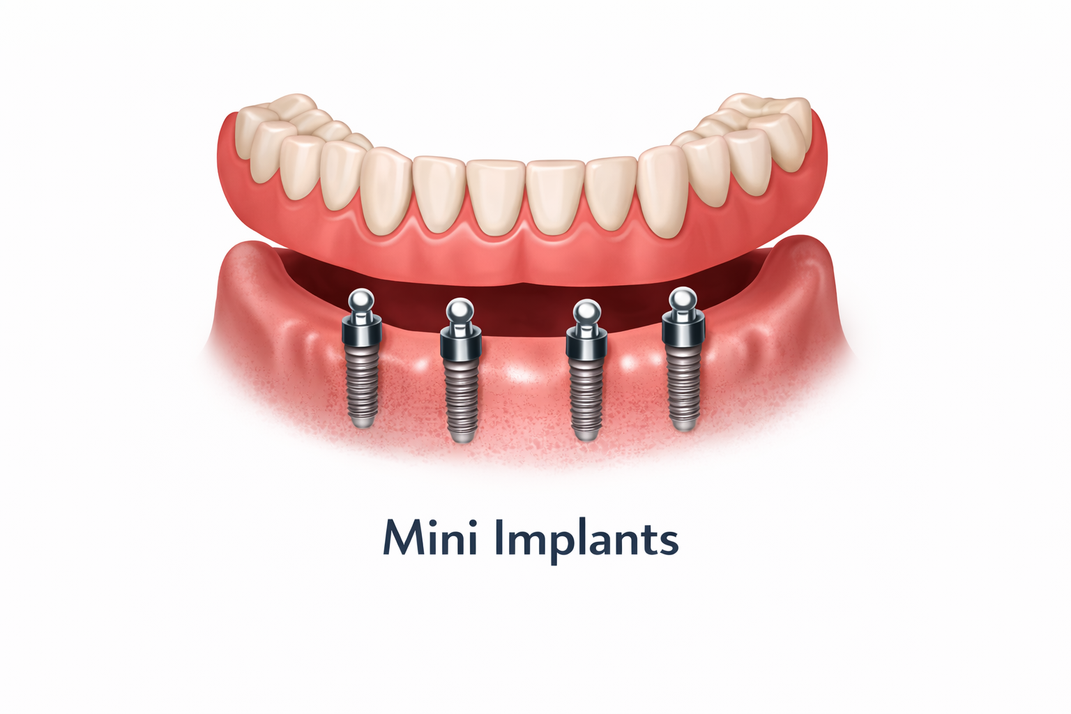 Mini Implants