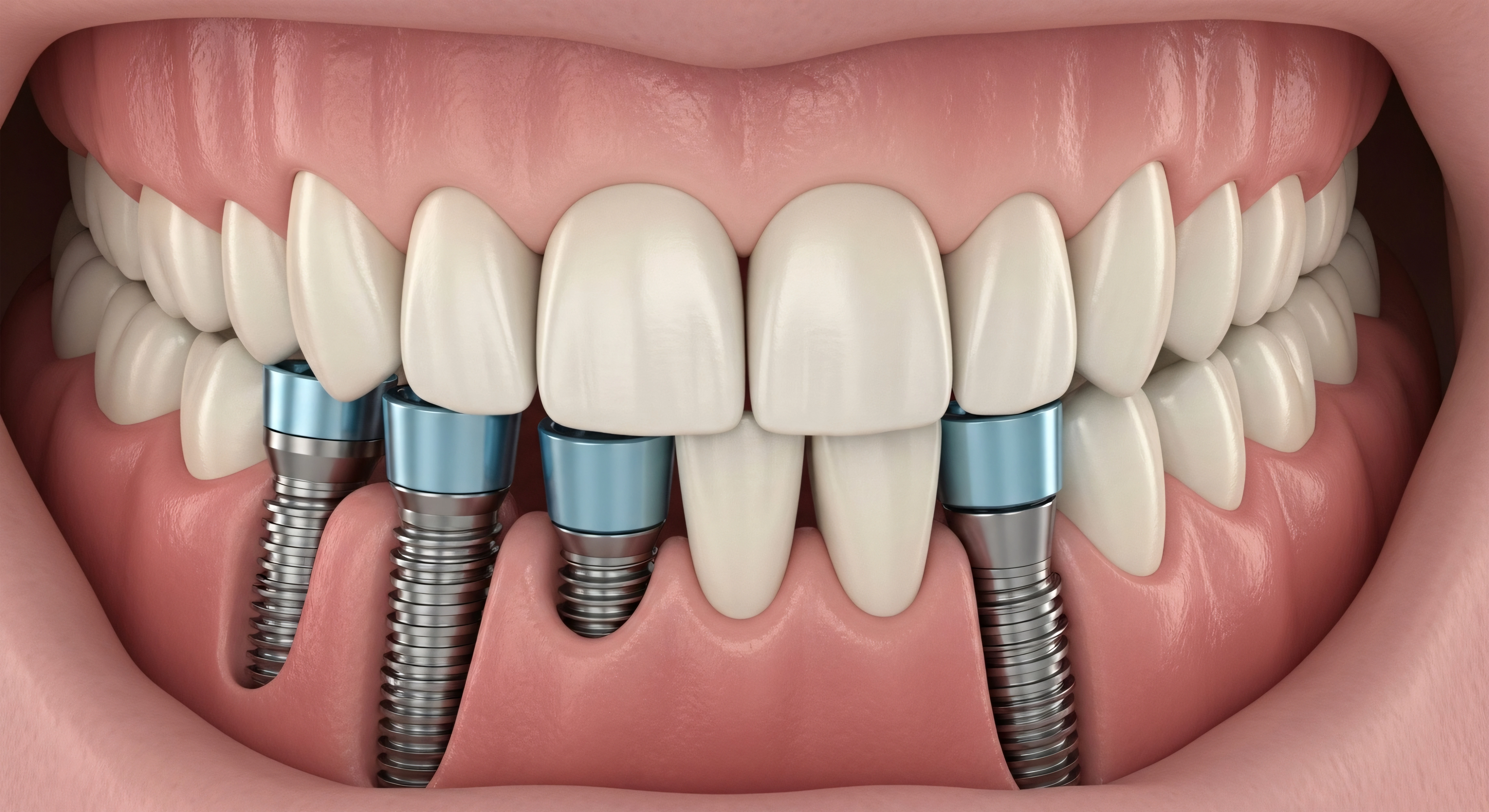 Multiple Tooth Implants