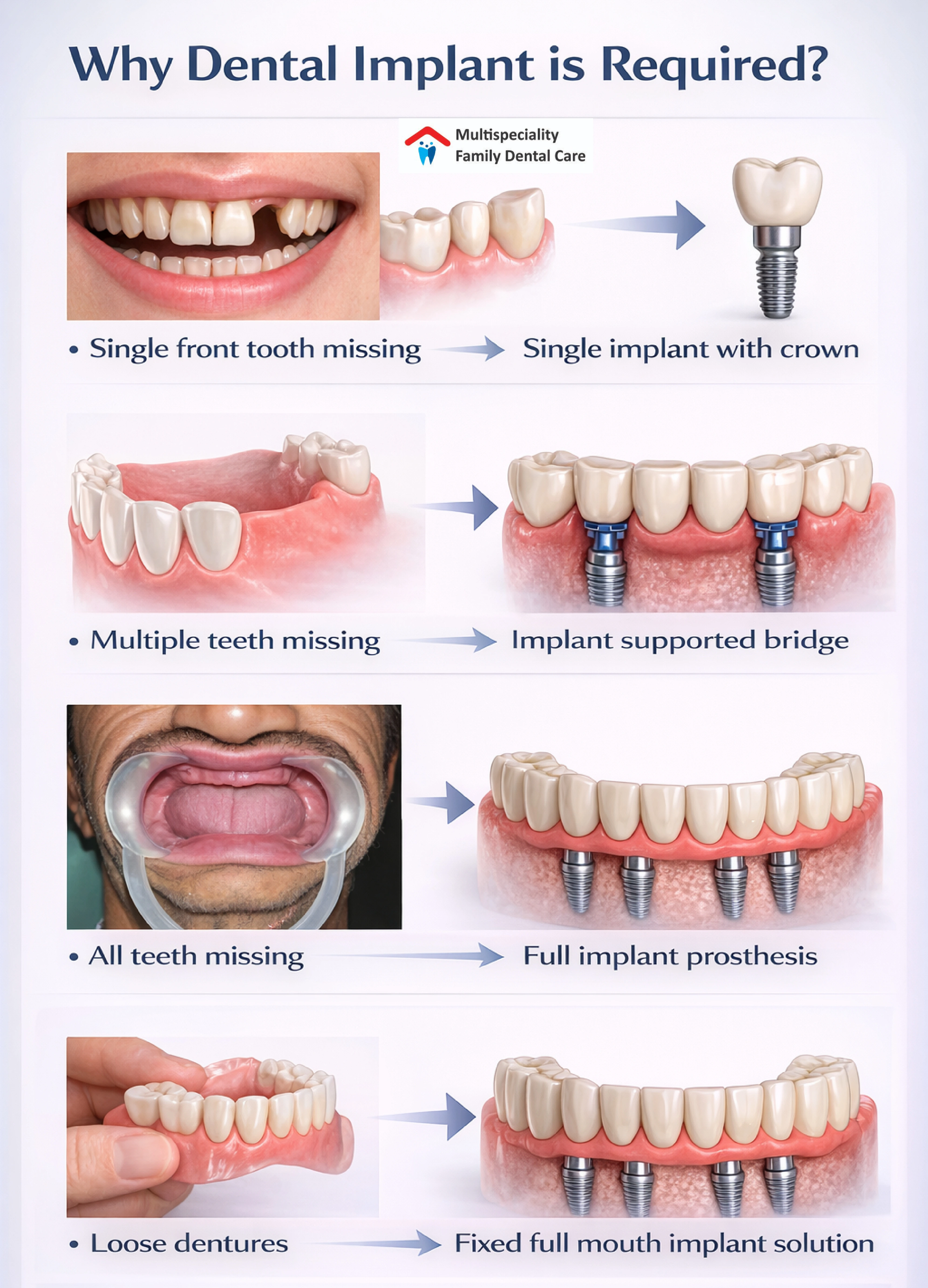why-are-dental-implants-required