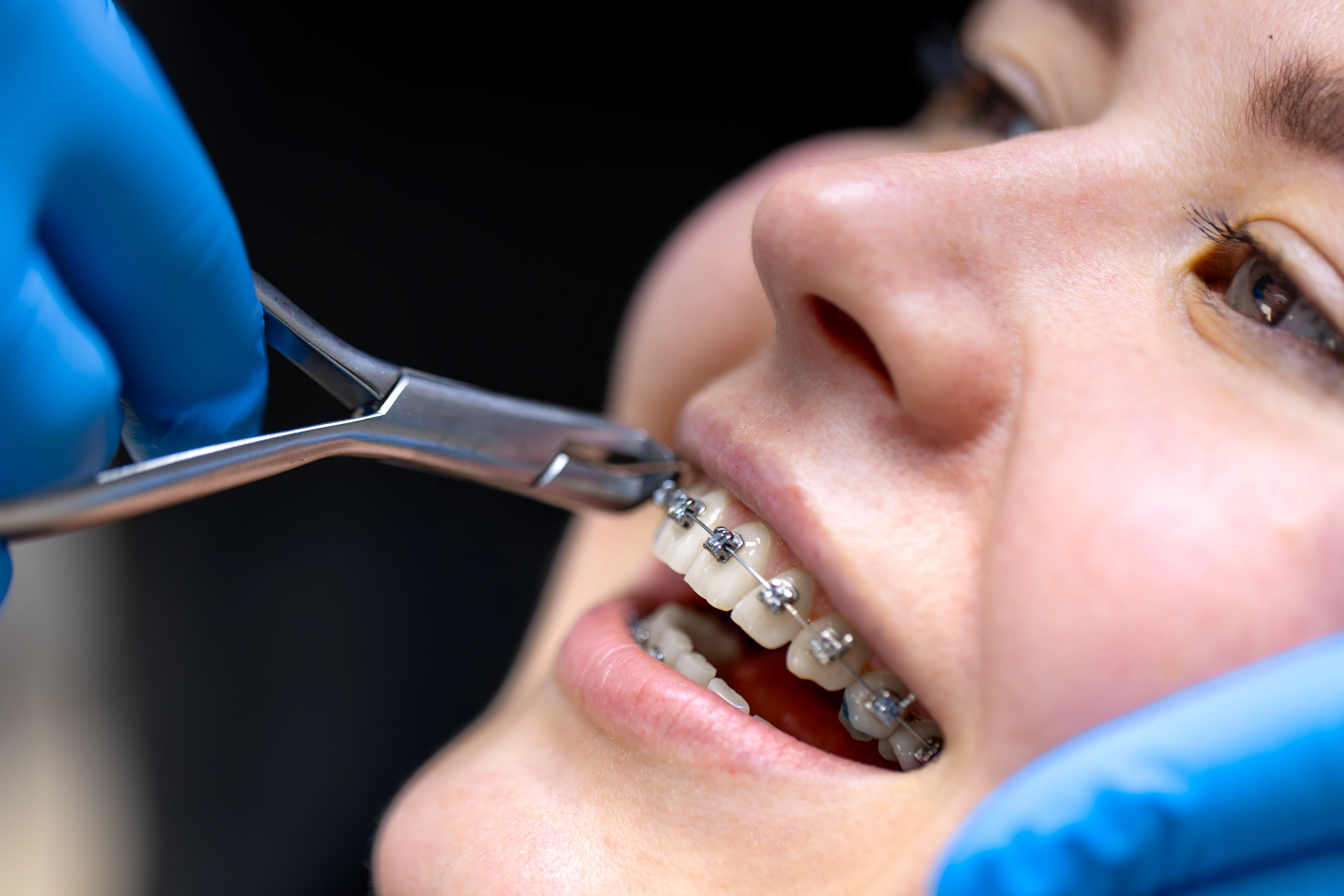Teeth Whitening